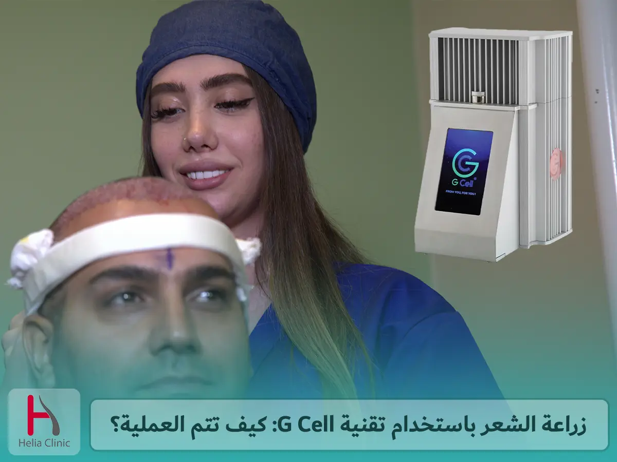 زراعة الشعر باستخدام تقنية G Cell: كيف تتم العملية؟