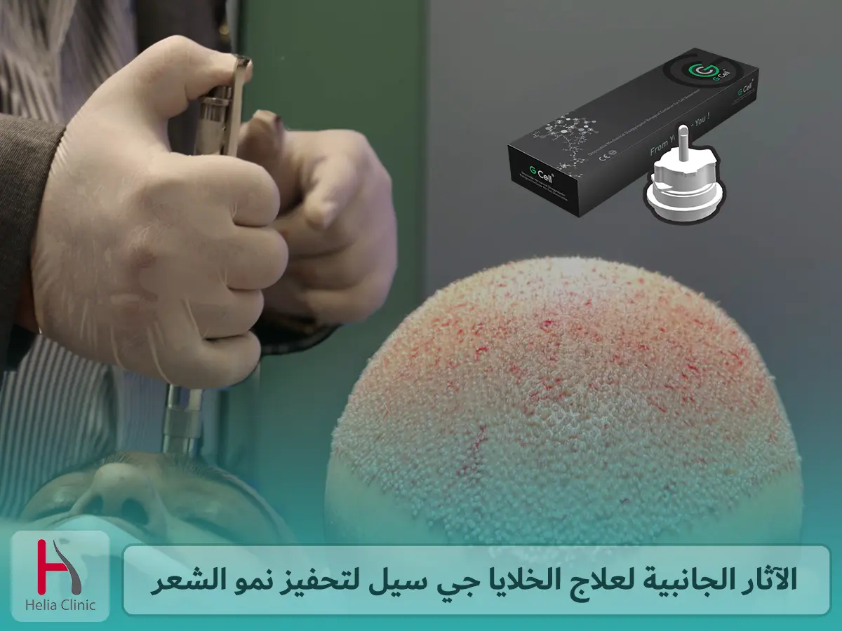 الآثار الجانبية لعلاج الخلايا جي سيل لتحفيز نمو الشعر وكيفية التعامل معها
