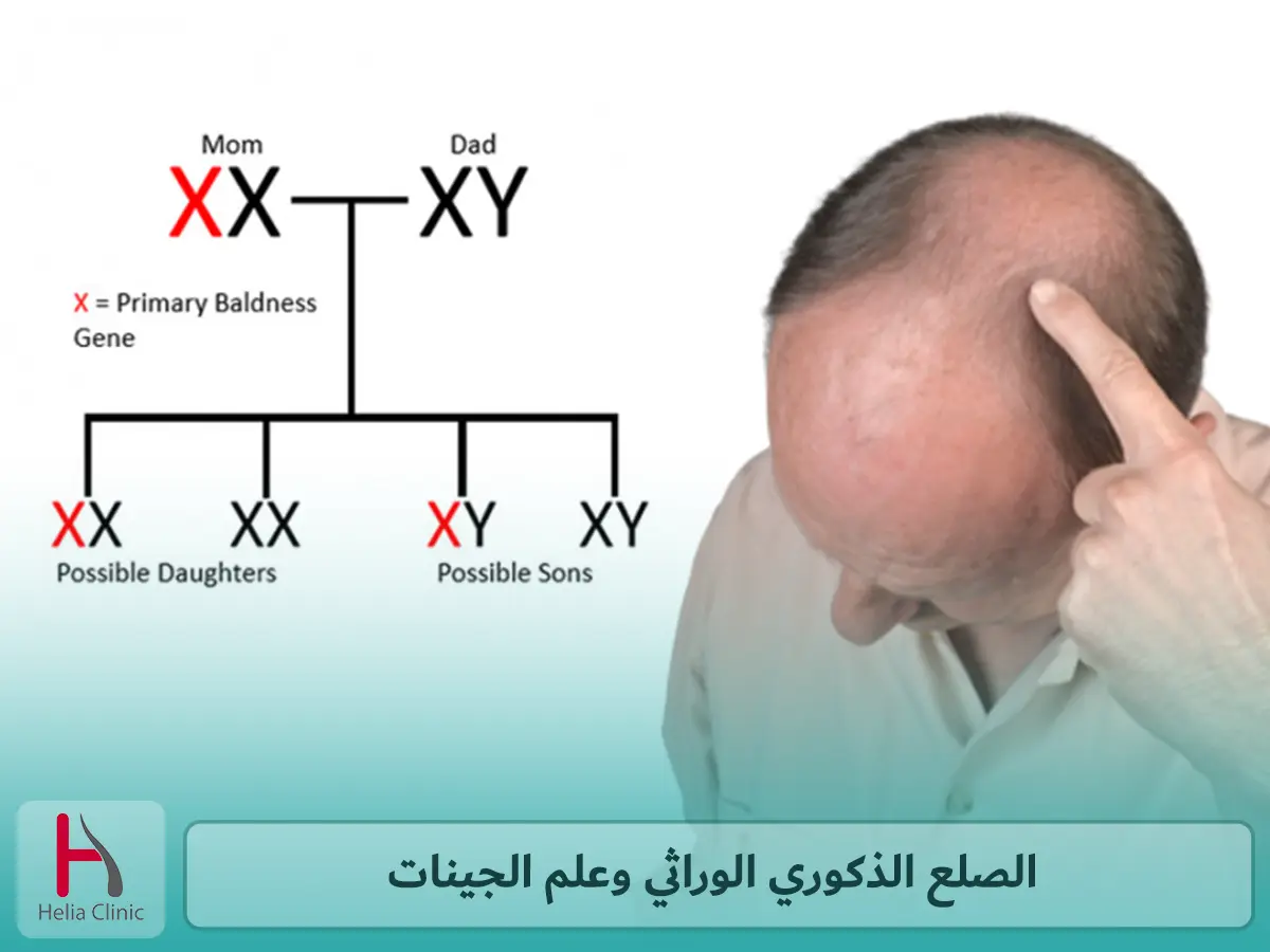 الصلع الذكوري الوراثي وعلم الجينات