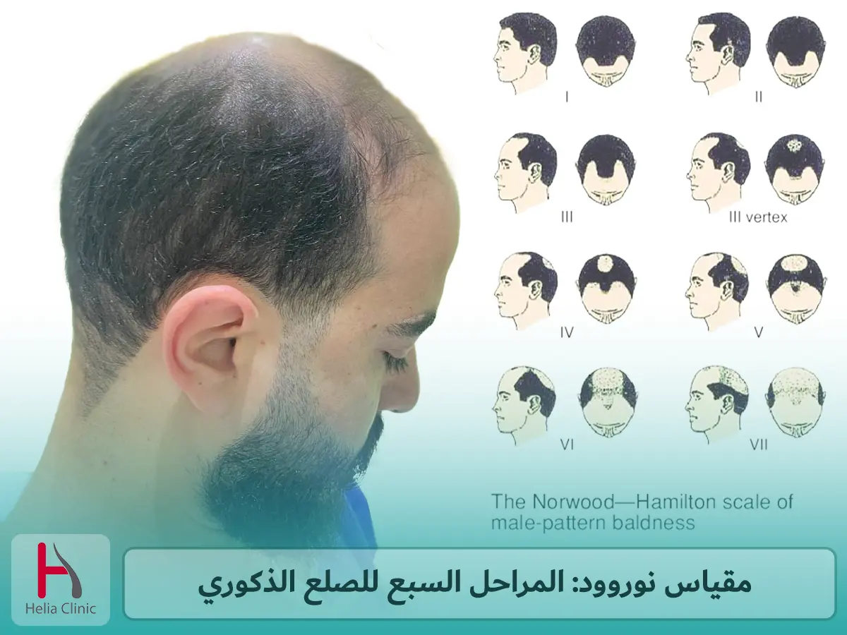 مقياس نوروود: المراحل السبع للصلع الذكوري