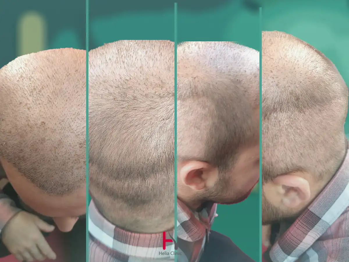 معرض صور زراعة الشعر