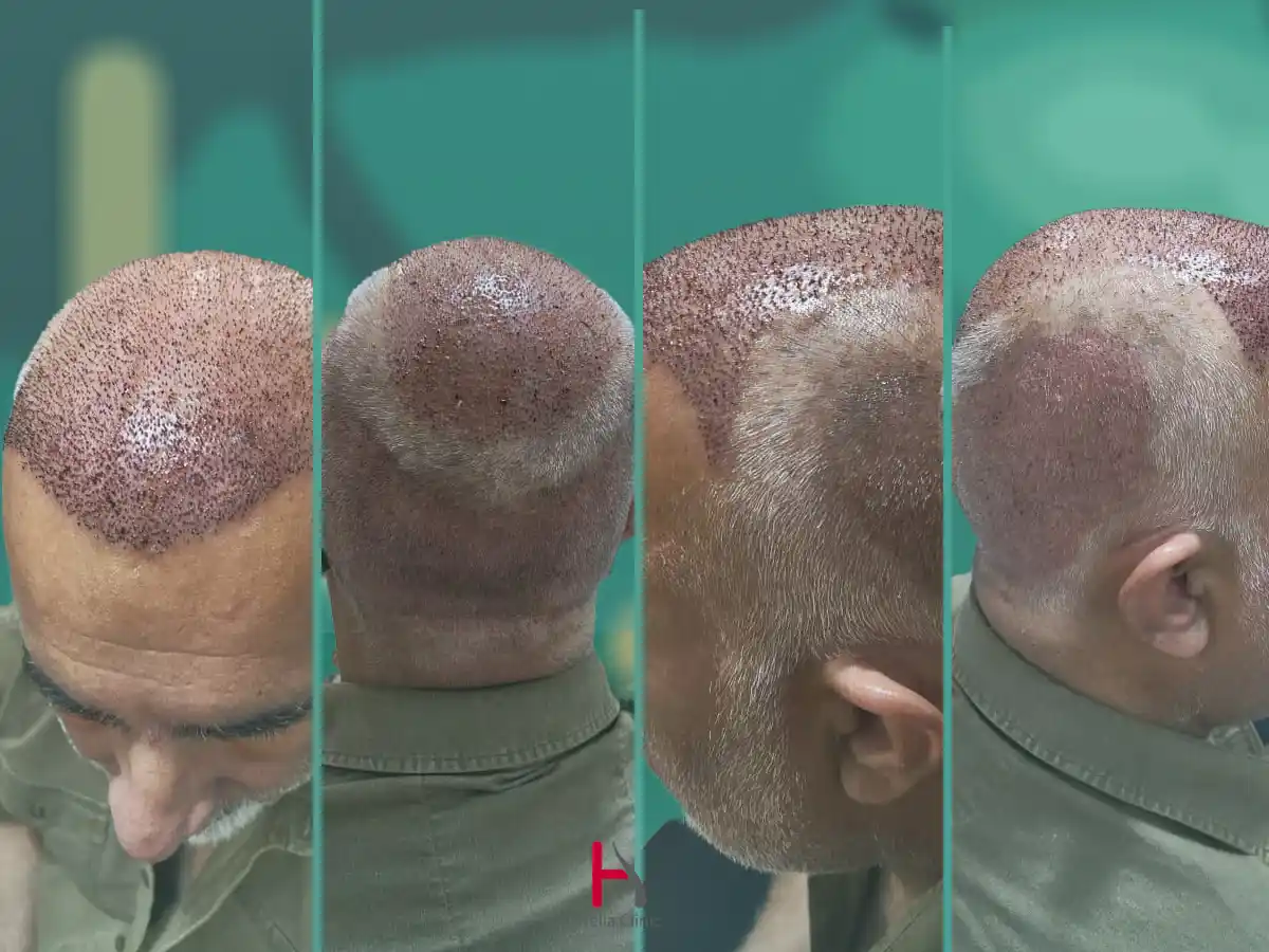 صور لزراعة الشعر من زوايا مختلفة