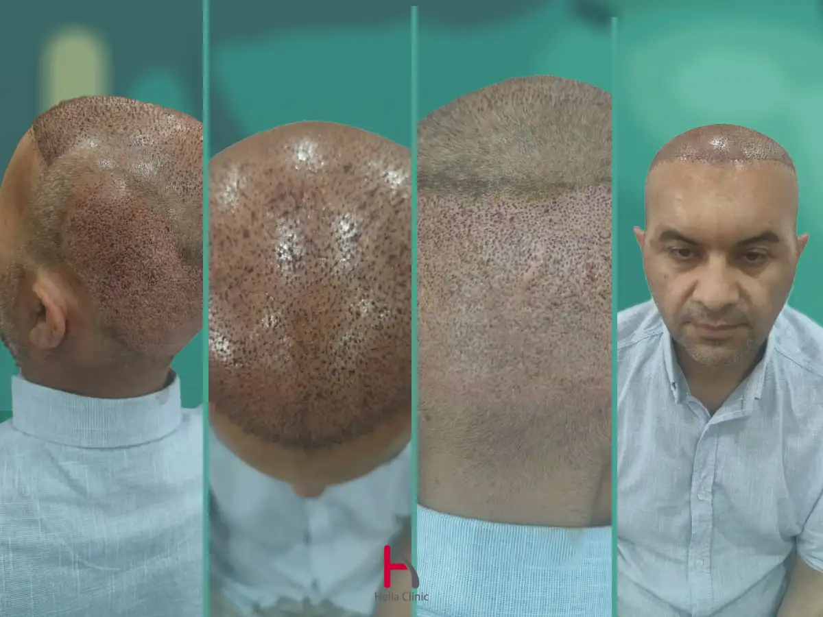 مجموعة صور قبل وبعد زراعة الشعر بجودة عالية في دبي