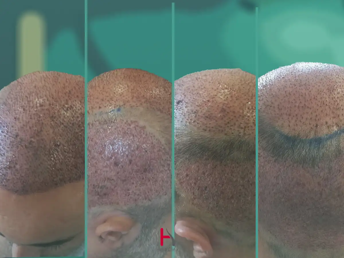 منظر جانبي لنتيجة زراعة الشعر