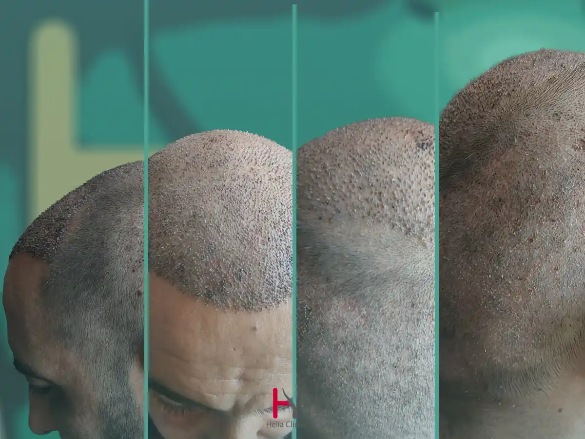 مجموعة صور قبل وبعد زراعة الشعر بجودة عالية