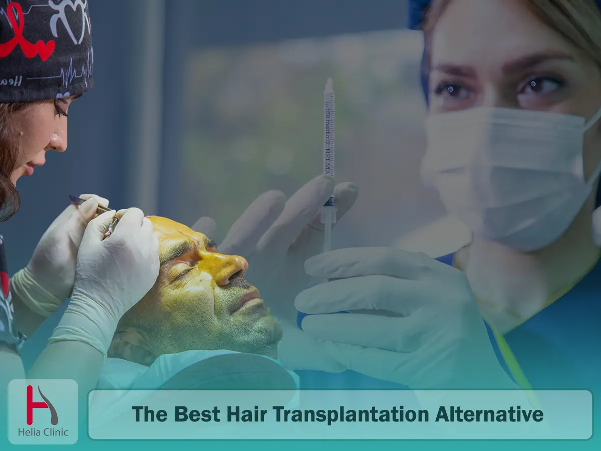 The Best Hair Transplantation Alternative