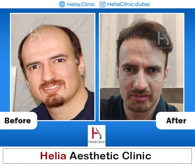 Hair transplant without shaving head before and after
