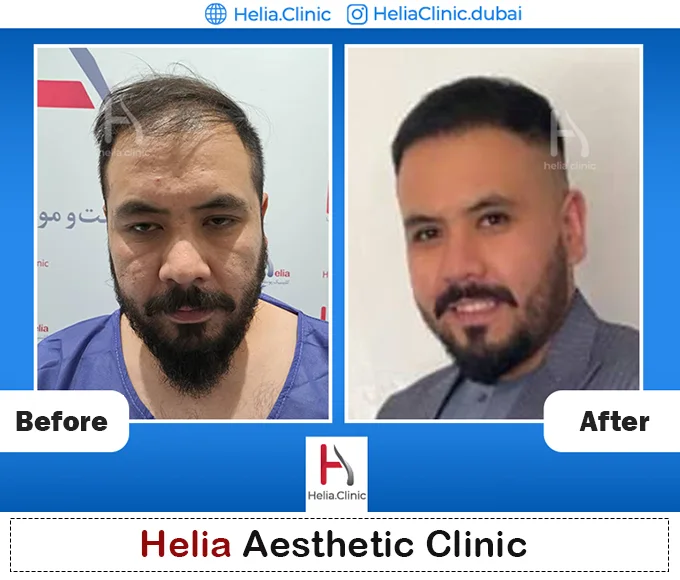 hair transplant without shaving head in dubai