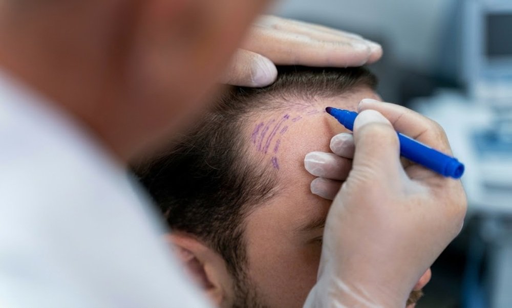 Hair Graft Calculator