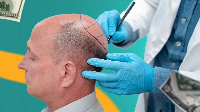Hair Transplant quality
