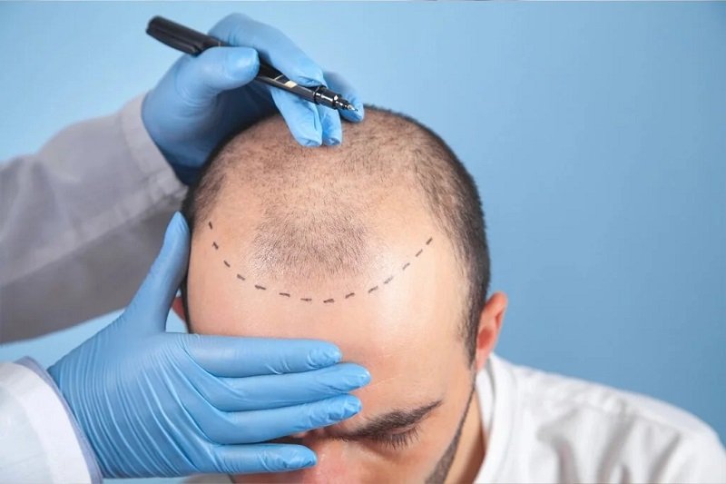 Why Is Turkey So Popular for Hair Transplants
