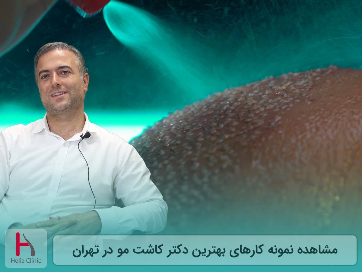 نمونه کارهای بهترین دکتر کاشت مو در تهران