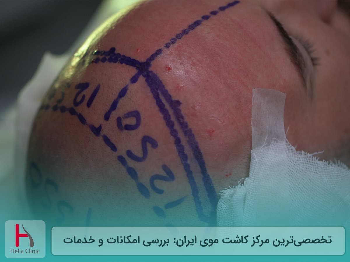 تخصصی‌ترین و مجهزترین کلینیک کاشت موی ایران