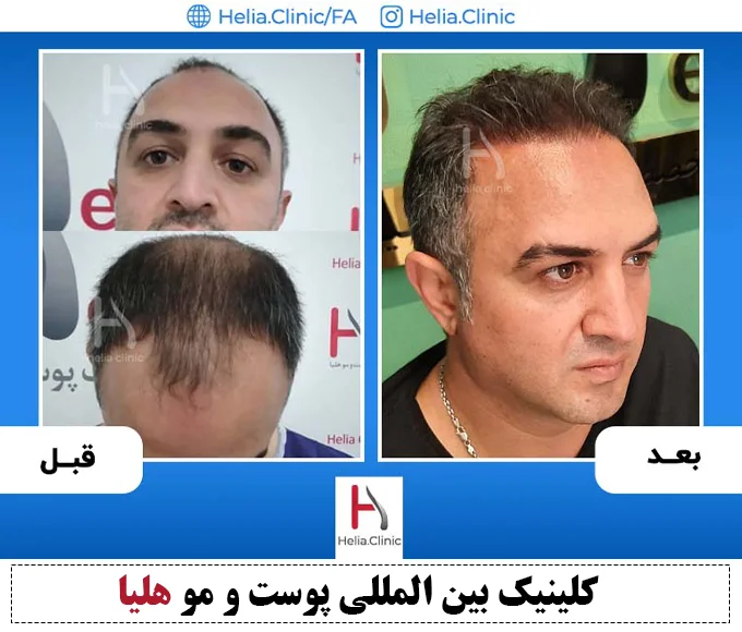 تجربه پیوند مو با دکتر خراسانی