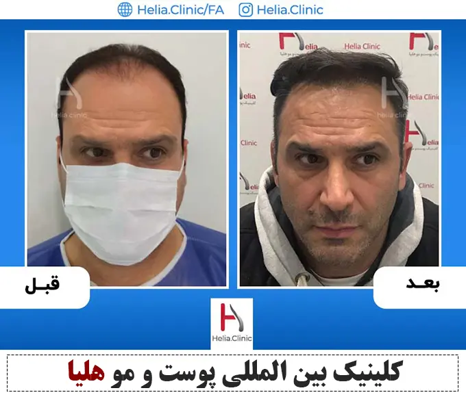 تصویر کاشت مو در بهترین کلینیک تهران