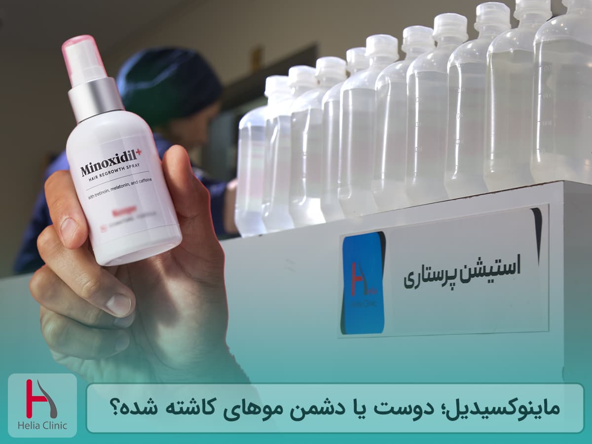 ماینوکسیدیل بعد از پیوند مو