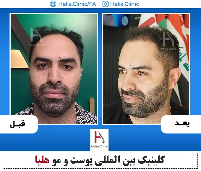 عکس بهترین دکتر کاشت مو