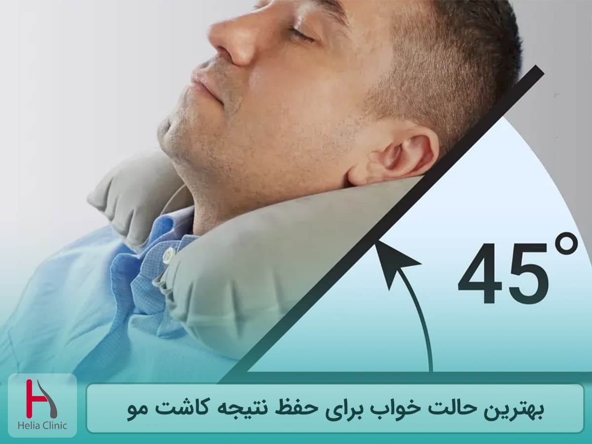 نحوه ی صحیح خوابیدن بعد از کاشت مو