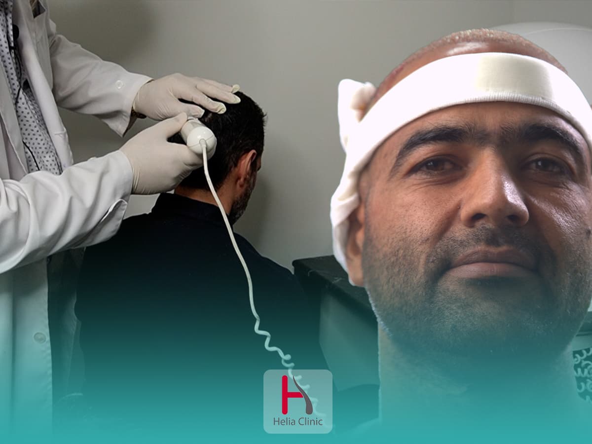 بهترین دکتر و کلینیک کاشت مو