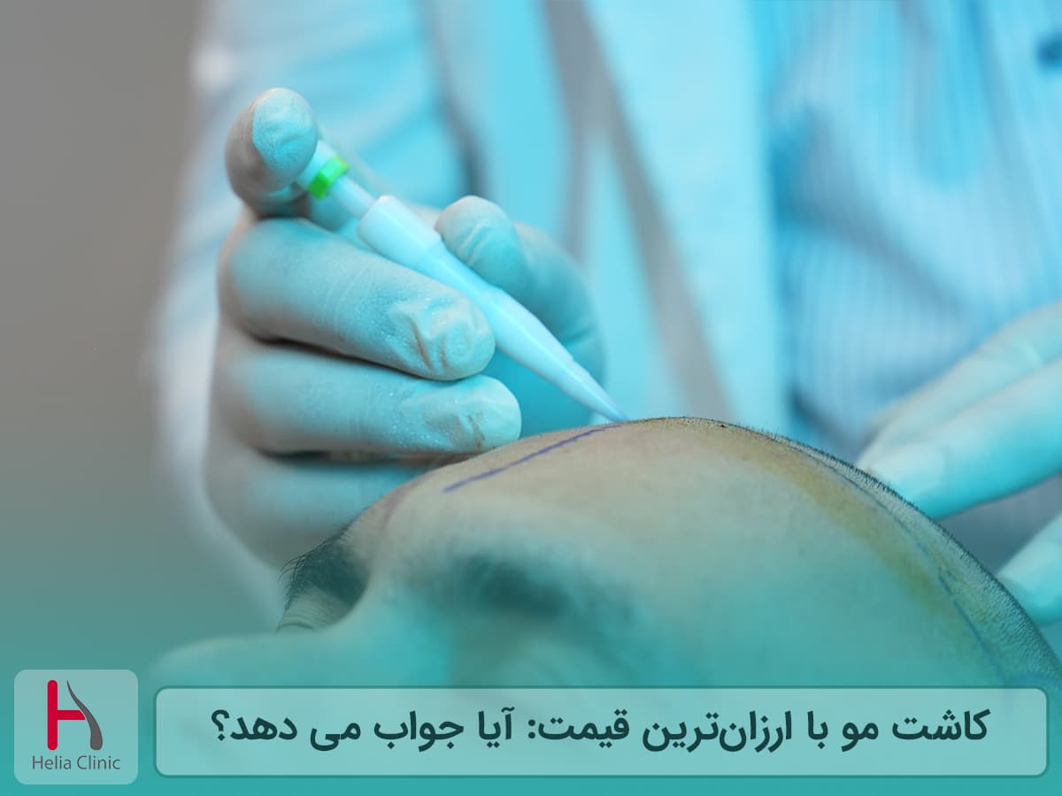 حداقل قیمت کاشت مو