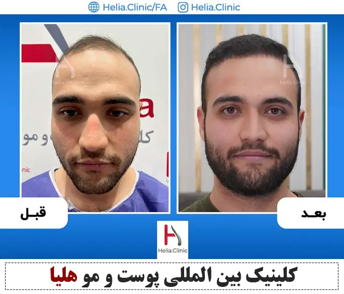 نمونه کار بهترین دکتر کاشت مو