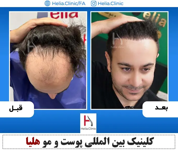 نتیجه کاشت مو توسط بهترین دکتر کاشت موی ایران