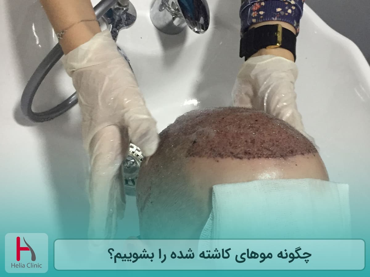 شستشوی صحیح سر بعد از کاشت مو