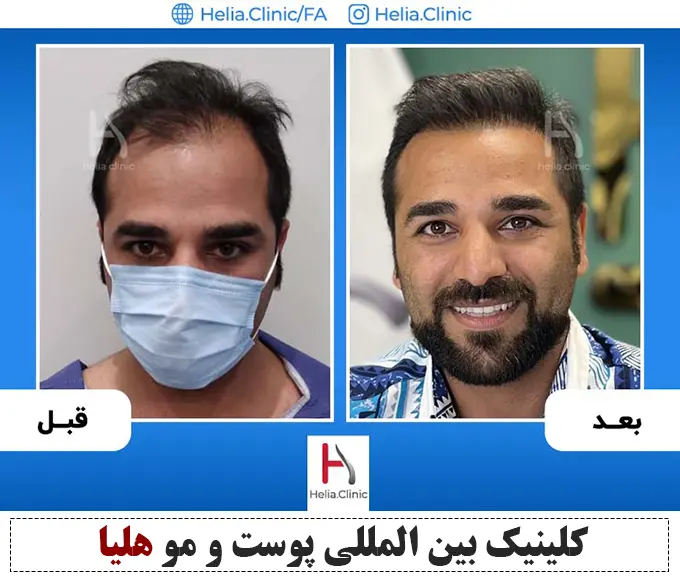 تصویر بهترین روش کاشت مو در جهان