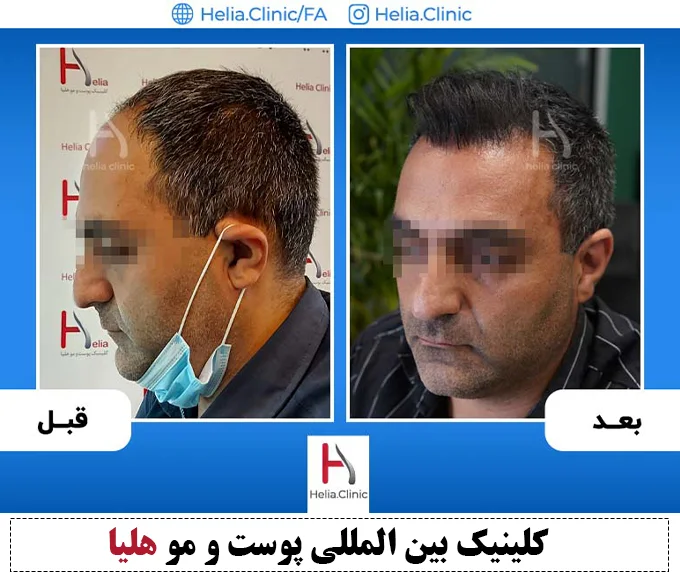 پیشرفته ترین تکنیک پیوند موی طبیعی