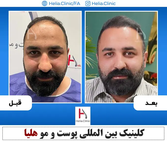 عکس جدیدترین روش کاشت مو با تراکم بالا