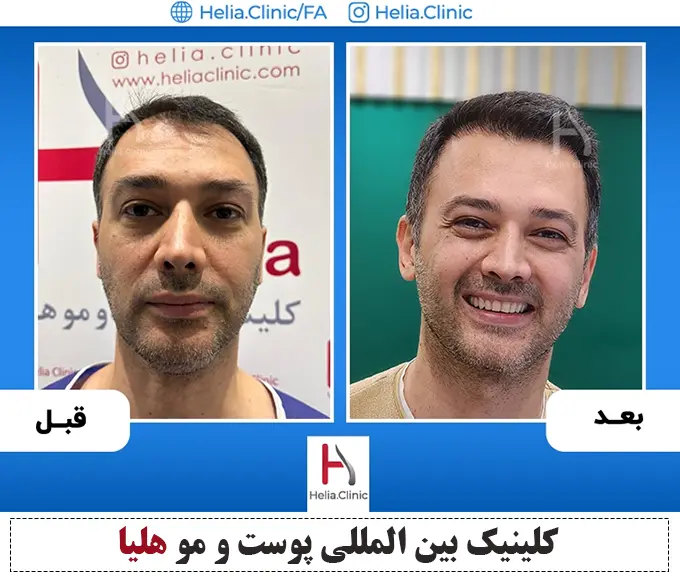 نمونه کار موثرترین روش کاشت مو