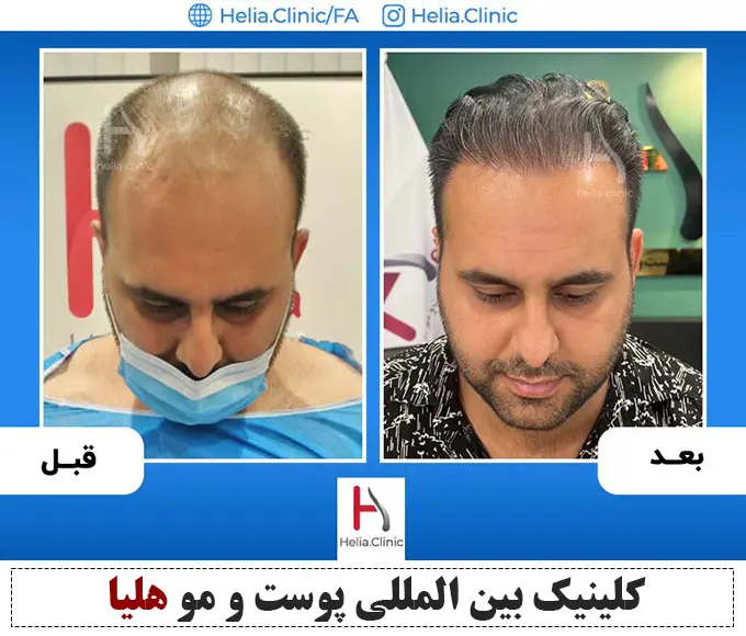 نمونه کار جدیدترین متد کاشت مو در ایران