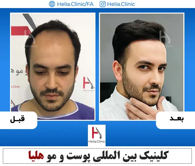نتیجه جدیدترین روش کاشت مو با دستگاه
