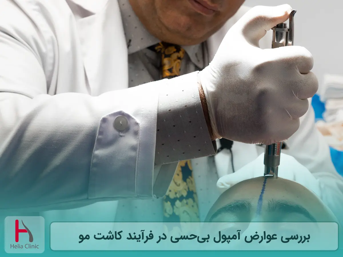 عوارض آمپول بی‌حسی کاشت مو