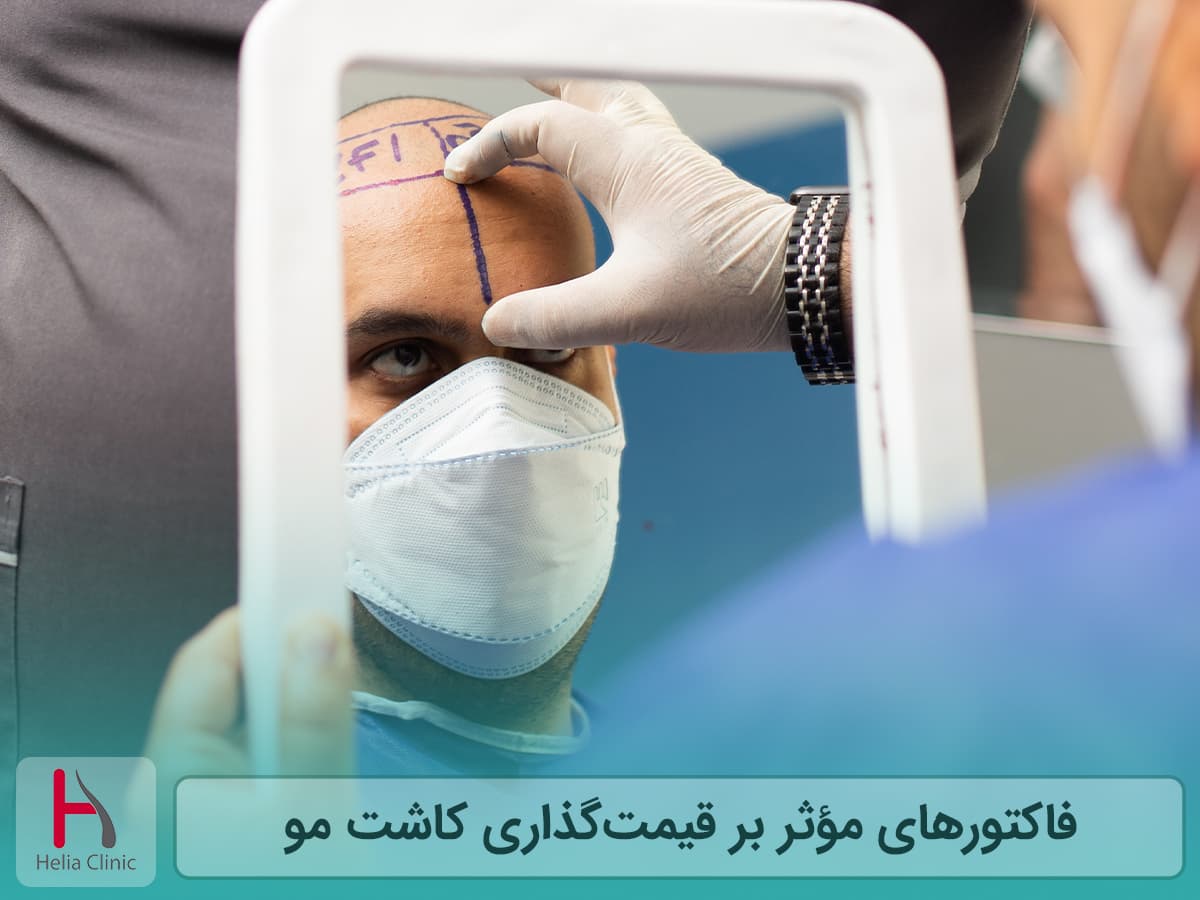 موارد تاثیرگذار بر هزینه کاشت مو