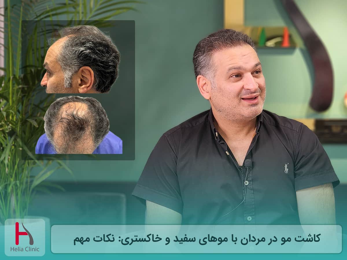 کاشت مو در مردان با موهای جوگندمی و سفید