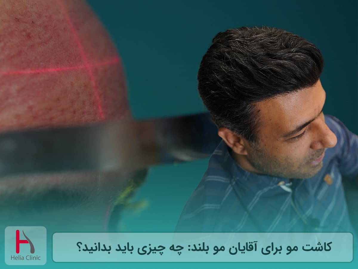 کاشت مو در مردان با موهای بلند