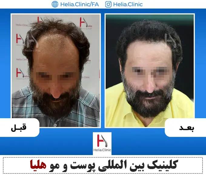 کاشت مو توسط دکتر خراسانی