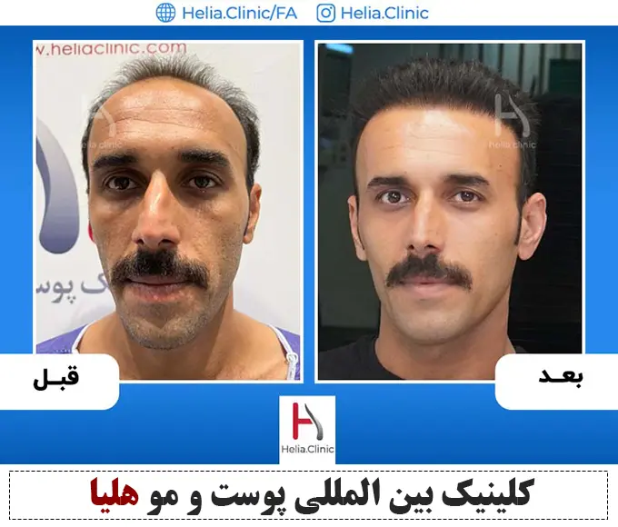 نمونه کار کاشت مو کلینیک هلیا