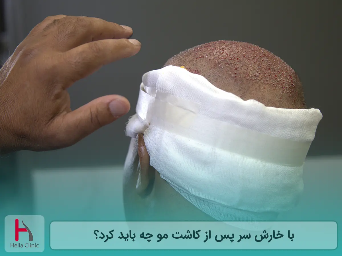 خارش کف سر پس از کاشت مو