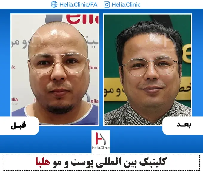 هزینه کاشت مو جدید