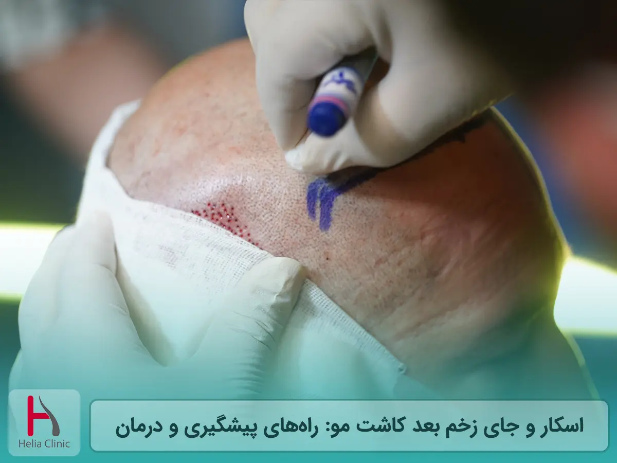 اسکار و جای زخم بعد از کاشت مو