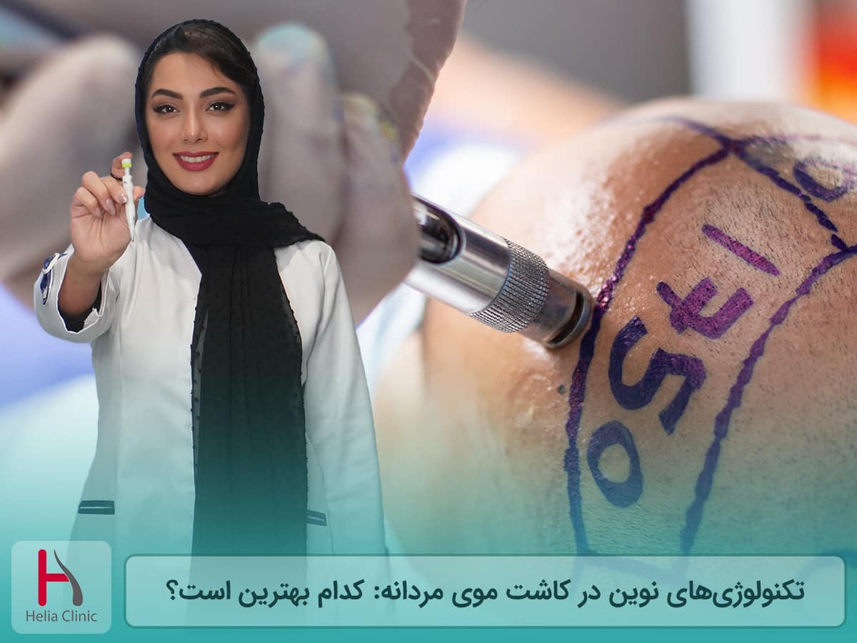 بهترین و جدیدترین روش کاشت مو در مردان