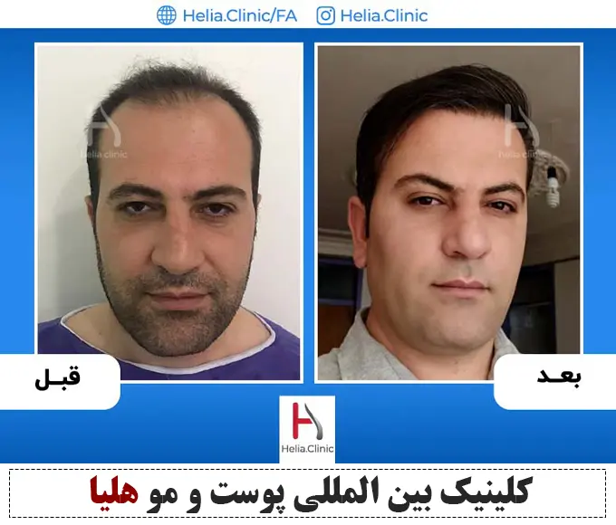 هزینه کاشت مو حرفه ای