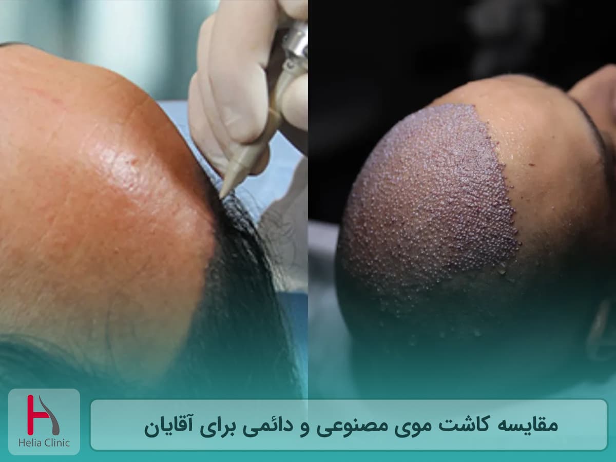 تفاوت کاشت موی مصنوعی و طبیعی در مردان