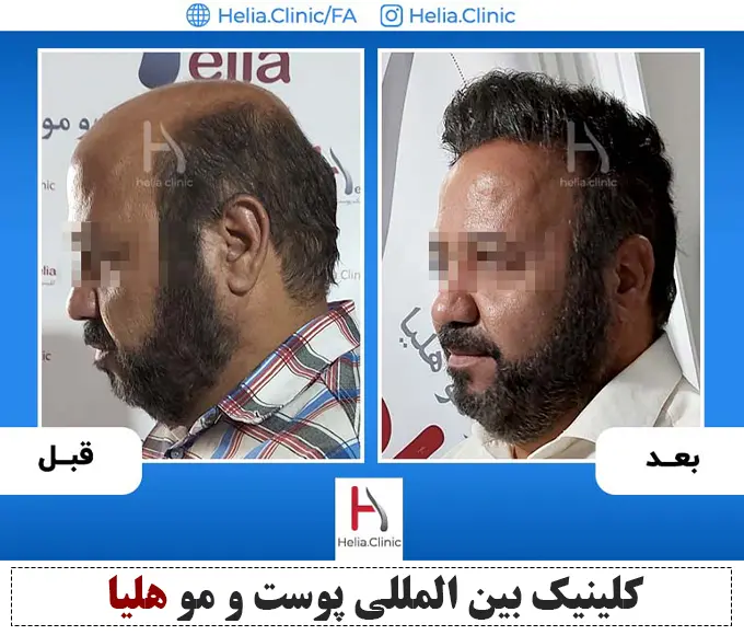 قیمت کاشت هر تار مو