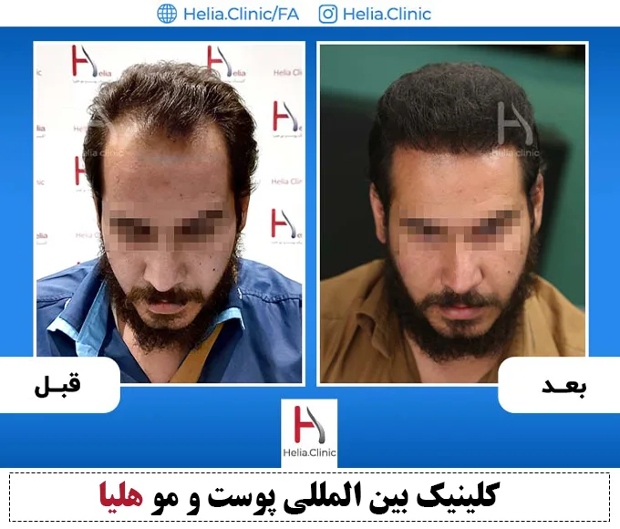 قیمت پیوند مو توسط دکتر حمیدرضا خراسانی