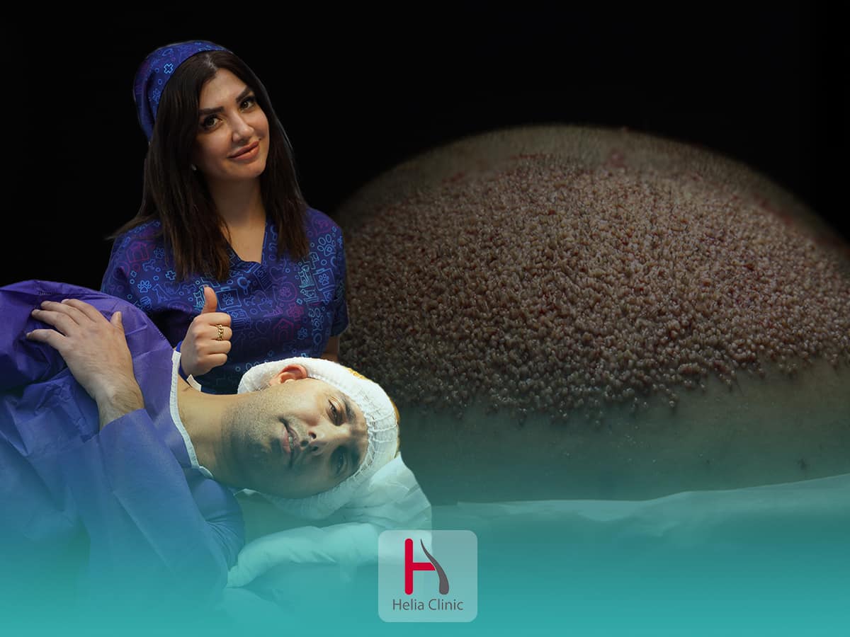 عوارض احتمالی کاشت مو