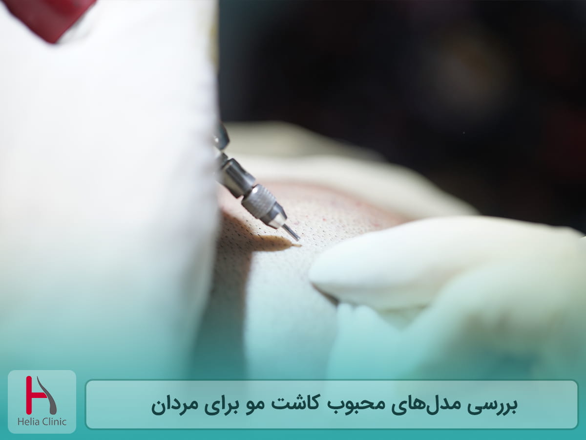 مدل های کاشت موی مردانه