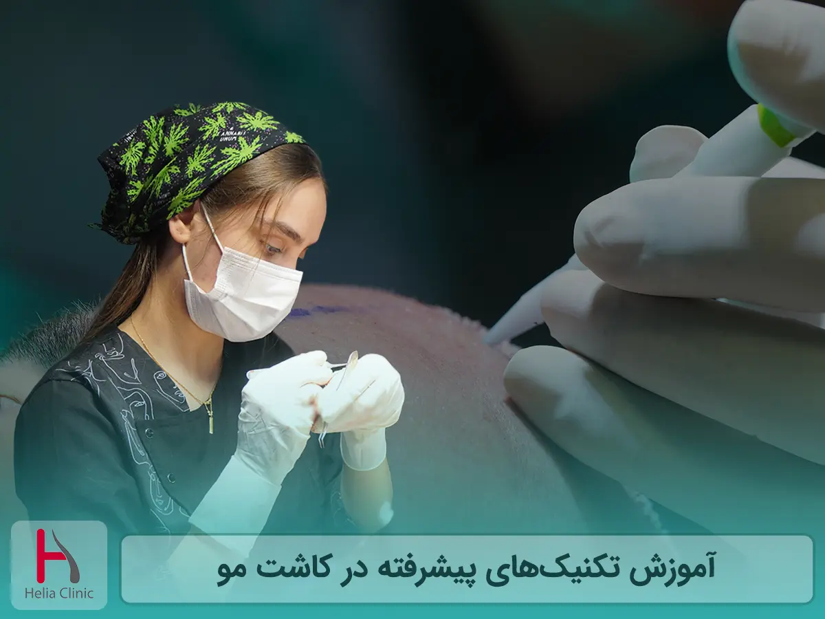 آموزش تکنیک های جدید کاشت مو